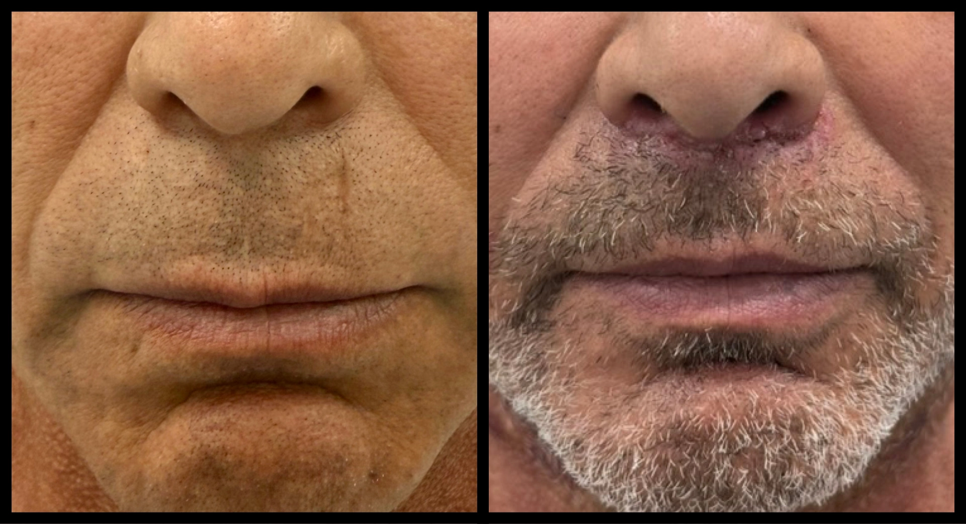 Lip lift before and after photo 1 - transformation results at Elevé Cosmetic Surgery Miami